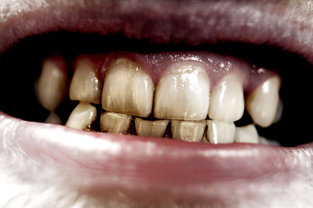 Mostrar la cruda realidad que implicar ‘pasar’ del dentista, la mejor manera de promover las visitas a las clínicas dentales